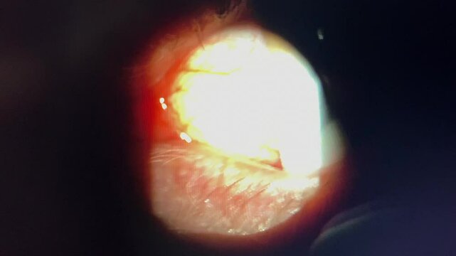 Scope view: Meibomian oil expressed from glands in eyelids, medical