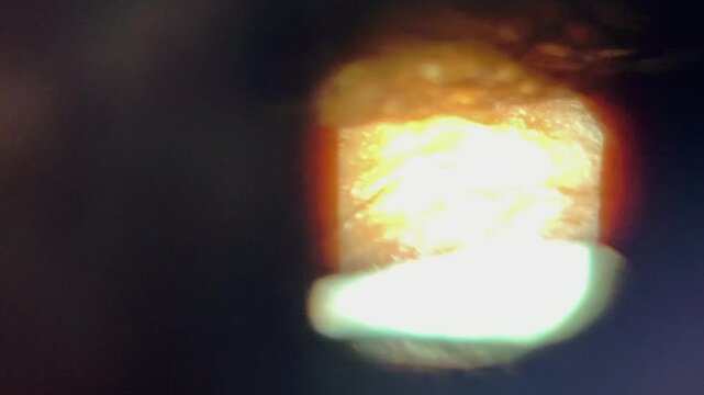 Medical scope: Patient's eye as meibomian oil glands are expressed