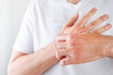 Man scratches or shows hands with dry, cracked skin on white backgrounds. Problem with many people...