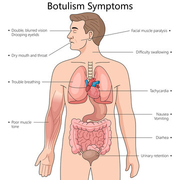 symptoms of botulism including vision issues, muscle paralysis, difficulty swallowing, respiratory problems diagram hand drawn schematic raster illustration. Medical science educational illustration