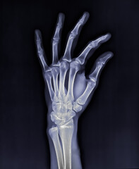 X-rayed human hand with finger. X-ray of hand bones