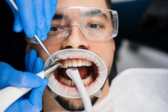 Airflow teeth cleaning in dental clinic. Assistant helps dentist to prepare teeth before treatment using airflow instrument.