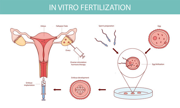 In Vitro Fertilization Diagram