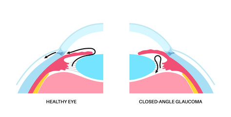 Glaucoma eye disease
