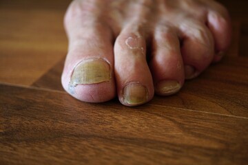 foot nail fungus wooden background close up - man showing yellow toenail fungal nails