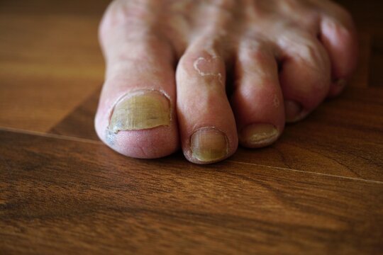 foot nail fungus wooden background close up - man showing yellow toenail fungal nails