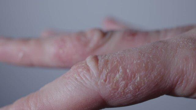 Close-up dry hand distinct redness sickness of eczema. Skin condition with eczema inflammation irritation with redness Dermatology of skincare routines Eczema symptoms dry skin palm hand redness