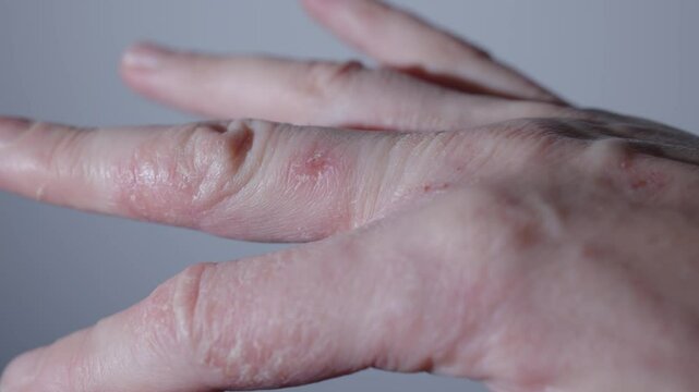 Palm hand exhibits redness bright sign of psoriasis close-up. Dermatology psoriasis inflammation irritation on dry skin illness sickness Dermatology psoriasis meticulously examined affected area