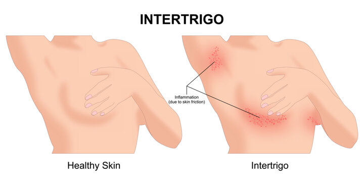 Intertrigo skin inflammation, rashes, redness, underarms, etc.