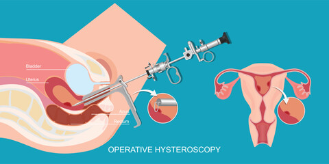 Operative hysteroscopy is a minimally invasive gynecological procedure.