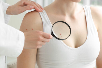 Doctor examining woman's mole with magnifying glass in clinic, closeup