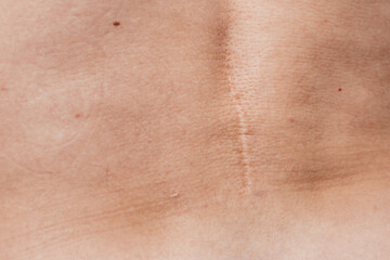 Fototapeta premium scar on the back after surgery for herniated disc 