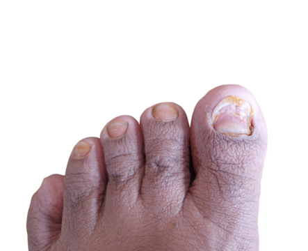 Image of feet that have been soaked in water for a long time and toenails that have fallen off.