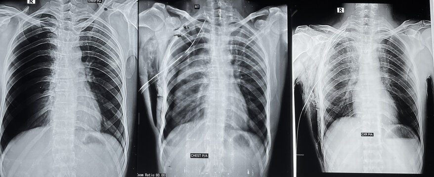 Chest x ray of pneumothorax and treatment by chest drain tube 