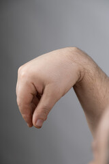 Ganglion cyst or hygroma of the wrist on the hand of a male patient