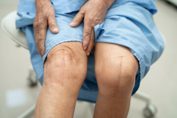 Asian elderly woman patient show her scars surgical total knee joint replacement Suture wound surgery arthroplasty.