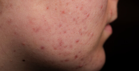 Skin texture background. Closeup acne pimple. Treatment for skin. Problem skincare. Pimples, acne,...
