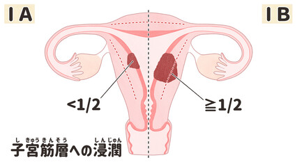Endometrial cancer (Uterine cancer) Stage1 diagram