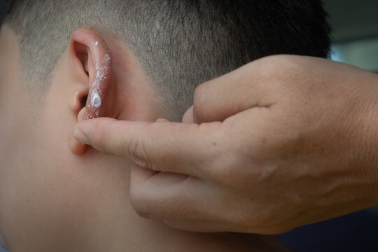 Parent&rsquo;s hand applying treatment cream on son&rsquo;s ear who illness with inflamed skin from Atopic dermatitis. Selective focus at antihelix and scaphoid fossa of earlobe.
