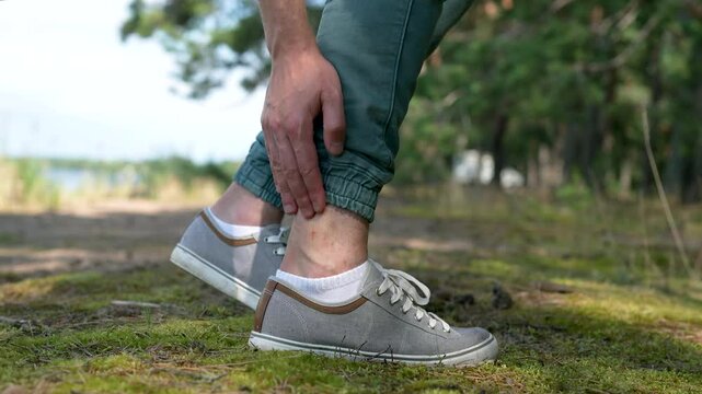 Man with mosquitoes bites, itching leg, applying balm or cream on swell skin, suffering from allergic reaction. Individual intolerance to insect bites. Male attacked by gnats in forest at summer