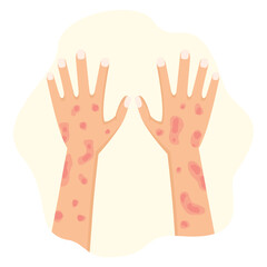 concept illustration of allergy causing itching, skin irritation, pox, flat style vector illustration.