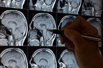 Doctor Analyzing Brain MRI Scans with Pen