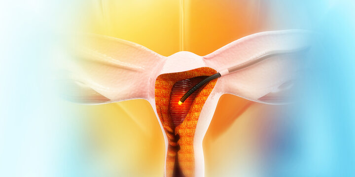 Dilation and curettage (d and c).endometrial biopsy.cervical cancer.3d illustration