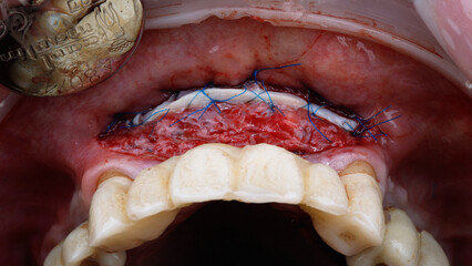 adding a flap of soft tissue to the upper jaw © Dental Pro Content