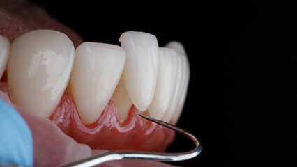 a beautiful moment of trying on a ceramic veneer on the lower jaw using a dental probe