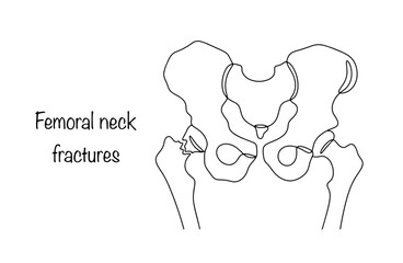 Femoral neck fractures