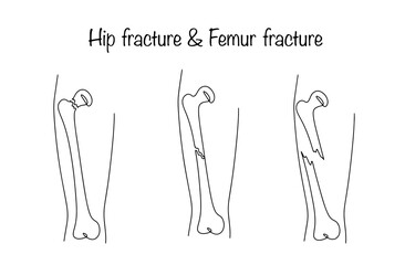 Hip fracture