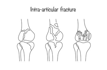 Intra-articular fracture