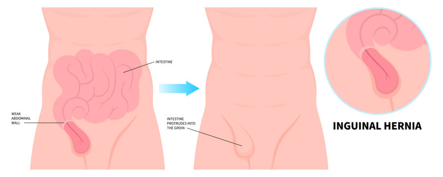 Umbilical hernia and intestine protrudes through abdominal muscles with stomach pain