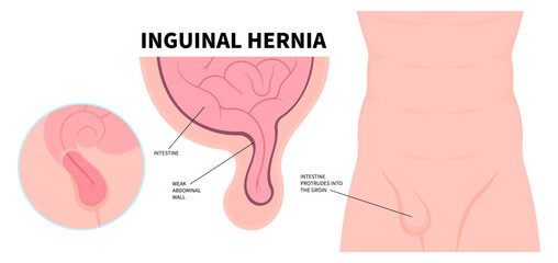 Stomach abdominal pain of large intestine constipation with belly button umbilical hernia or small inguinal incisional Femoral around navel lump