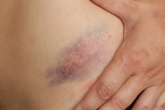 Close up view of a nasty bruise