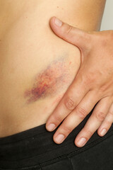 Close up view of a nasty bruise