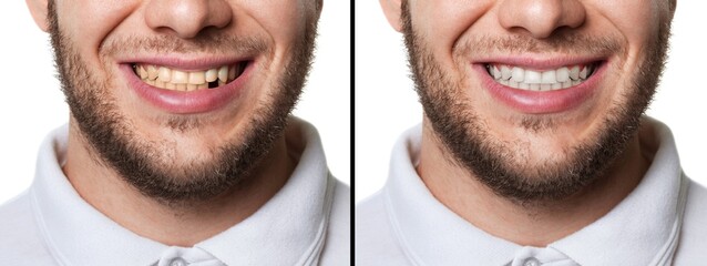 Young  smiling man before and after whitening. Dentistry concept
