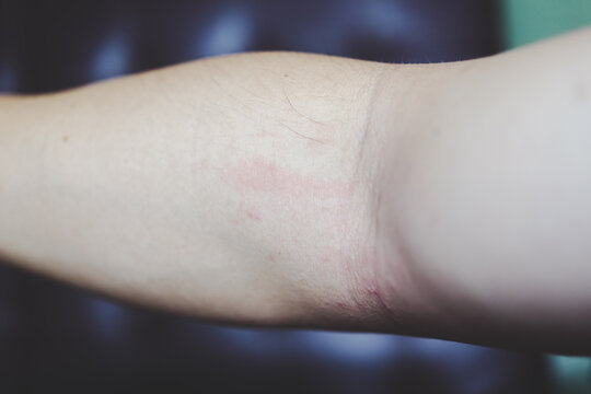 Cetirazine Rash รูปภาพCetirizine – เลือกดูภาพถ่ายสต็อก เวกเตอร์ และวิดีโอ266 | Adobe Stock