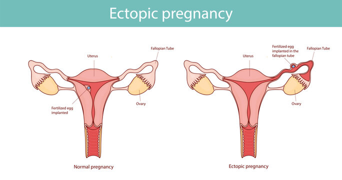 Ectopic pregnancy. Pregnancy problem compared to normal pregnancy in cartoon linear style.