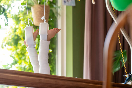 Child's legs in white casts hanging over a wooden bar, suggesting a recent injury and recovery process.