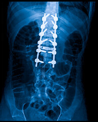 X ray of the human chest fracture fixation. Lumbar spine radiograph using steel screws to hold the...