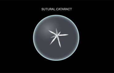 Cataract eye disease