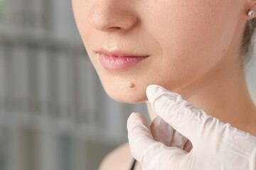 Doctor examining woman's mole in clinic, closeup