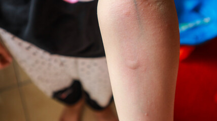 A close-up of a person's arm, revealing several bug bites. The bites are red and swollen with...