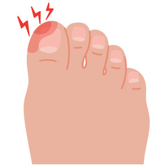 Vector swollen toe onychocryptosis cartoon foot with nail disease illustration