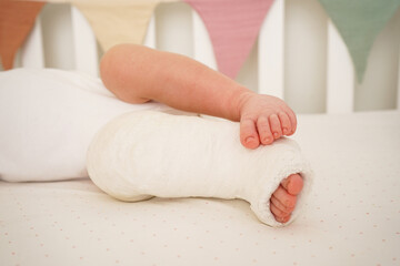 Newborn little baby with leg in a cast - clubfoot, close-up.
