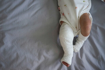 Top view newborn little baby with leg in a cast - clubfoot. Space for text.