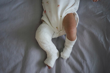 Top view newborn little baby with leg in a cast - clubfoot.