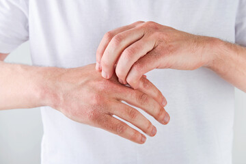 Man scratches or shows hands with dry, cracked skin on white backgrounds. Problem with many people - eczema on hand, allergies or dry skin. Health care concept. Close up.
