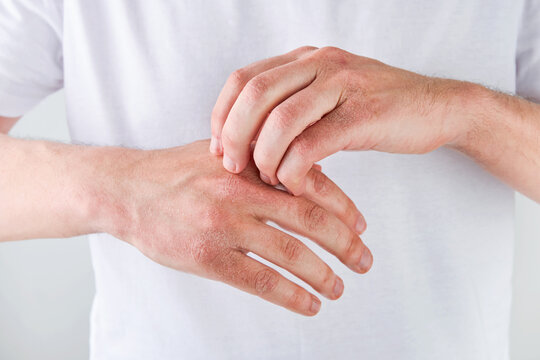 Man scratches or shows hands with dry, cracked skin on white backgrounds. Problem with many people - eczema on hand, allergies or dry skin. Health care concept. Close up.